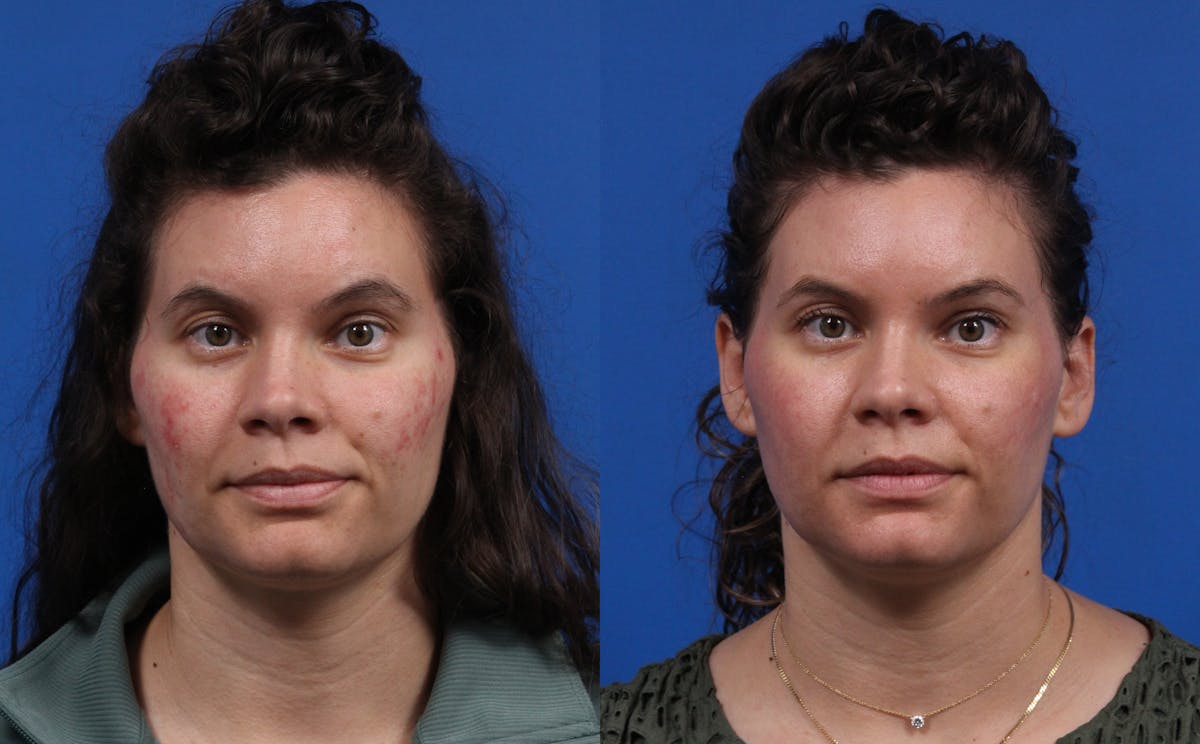 HALO® Laser by Sciton Gallery Before & After Gallery - Patient 408423 - Image 1