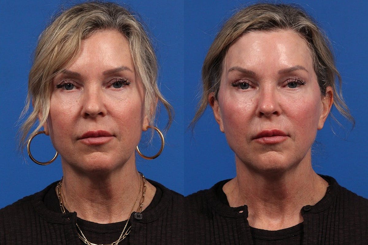 XERF Gallery Before & After Gallery - Patient 223911 - Image 1