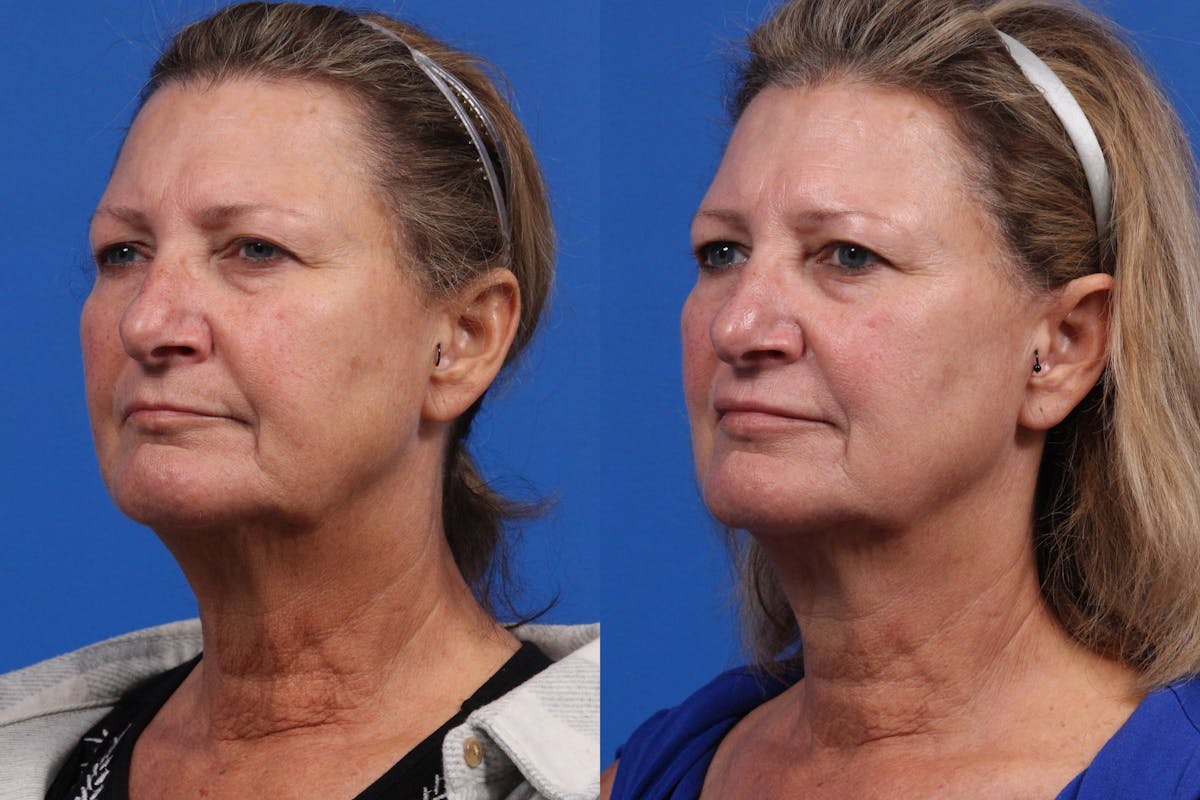 Morpheus8 Gallery Before & After Gallery - Patient 209970 - Image 1