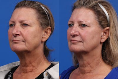 Morpheus8 Gallery Before & After Gallery - Patient 209970 - Image 1
