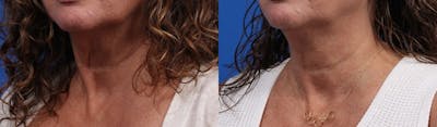 Morpheus8 Gallery Before & After Gallery - Patient 201638 - Image 2