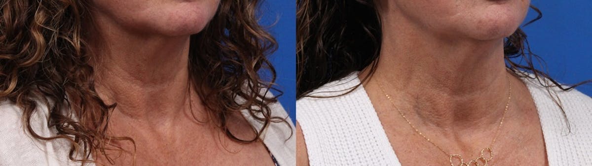 Morpheus8 Gallery Before & After Gallery - Patient 201638 - Image 1