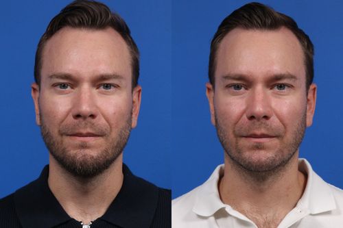 Excel V. Gallery Before & After Gallery - Patient 383288 - Image 1