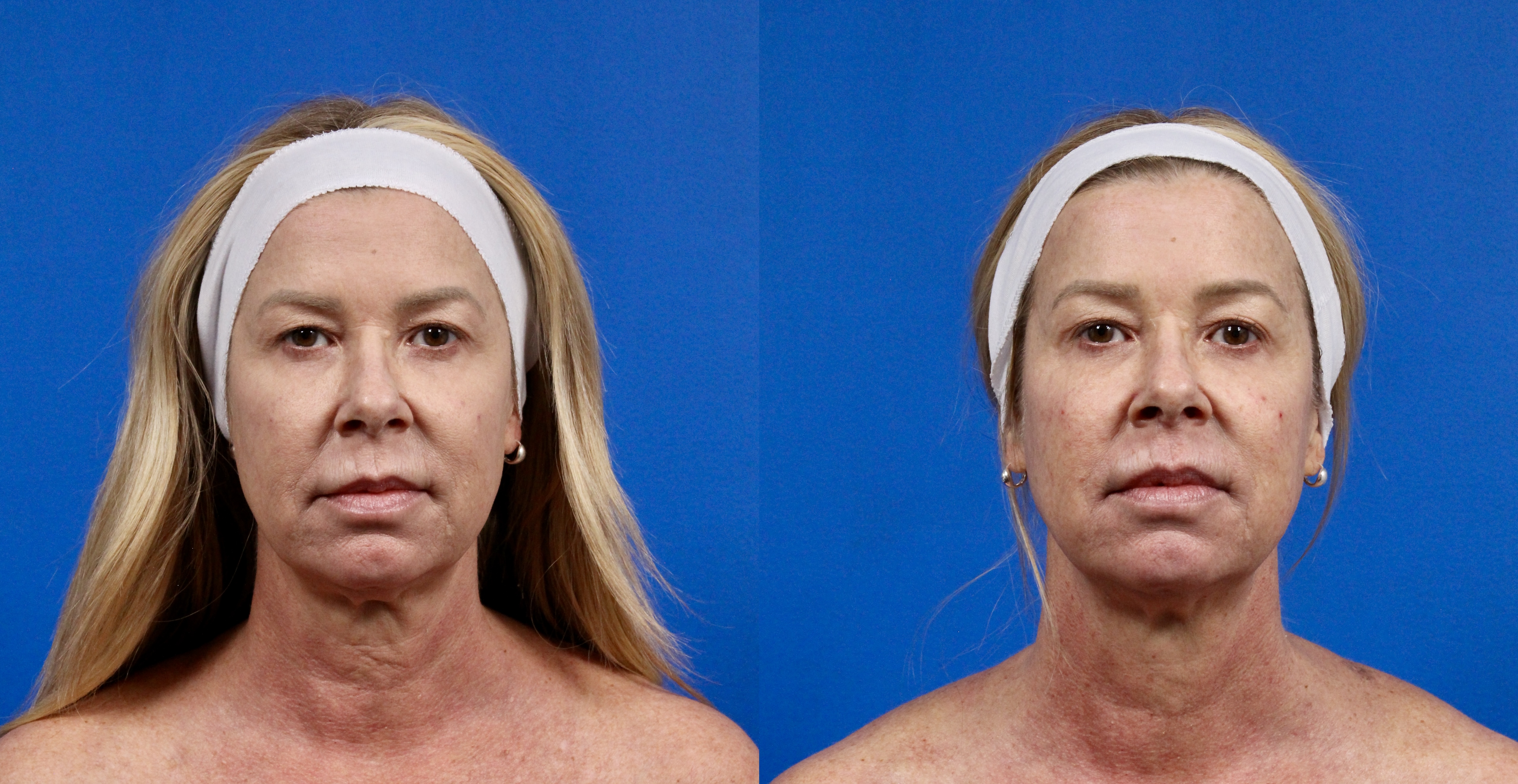 XERF Gallery Before & After Gallery - Patient 444461 - Image 1