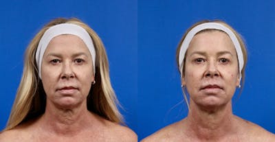 XERF Gallery Before & After Gallery - Patient 444461 - Image 1