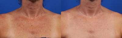 HALO® Laser by Sciton Gallery Before & After Gallery - Patient 373767 - Image 1