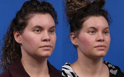 XERF Gallery Before & After Gallery - Patient 527272 - Image 1