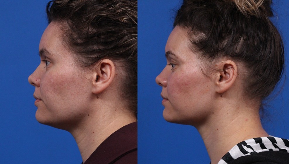 XERF Gallery Before & After Gallery - Patient 527272 - Image 2