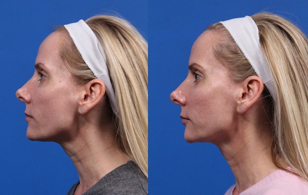 XERF Gallery Before & After Gallery - Patient 264777 - Image 2