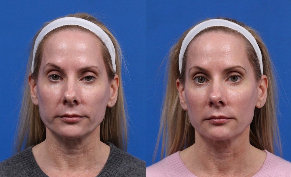 XERF Gallery Before & After Gallery - Patient 264777 - Image 1