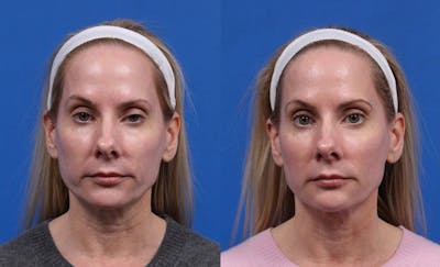 XERF Gallery Before & After Gallery - Patient 264777 - Image 1