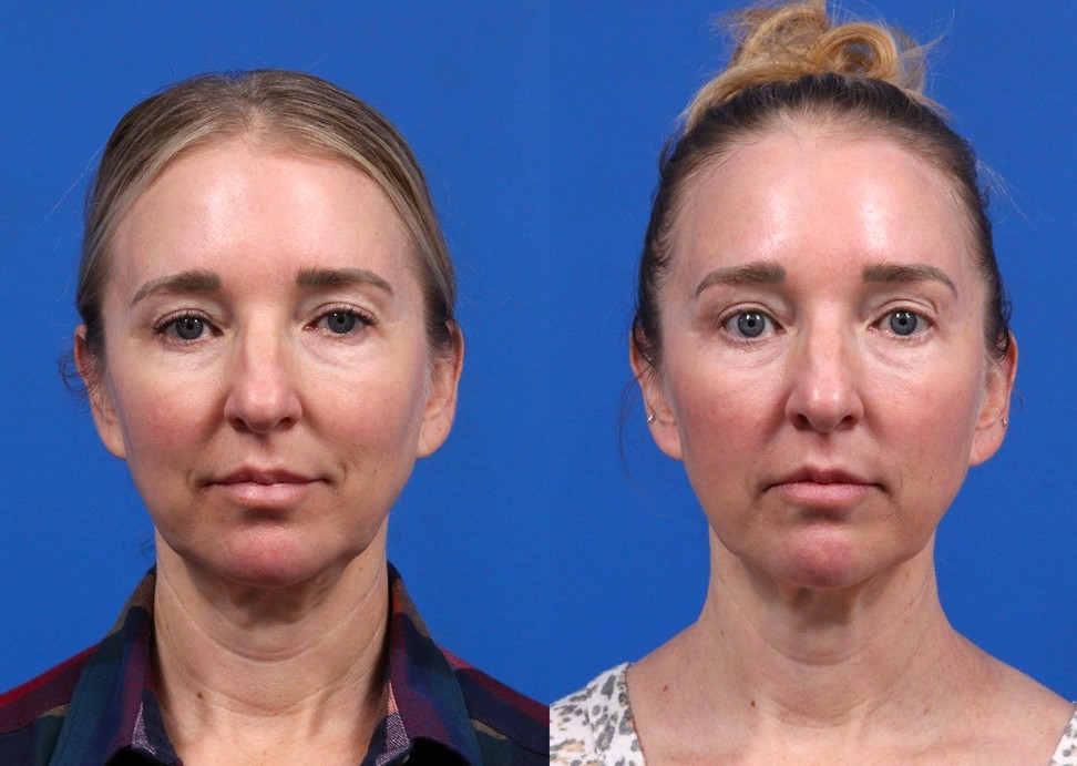 XERF Gallery Before & After Gallery - Patient 376951 - Image 2