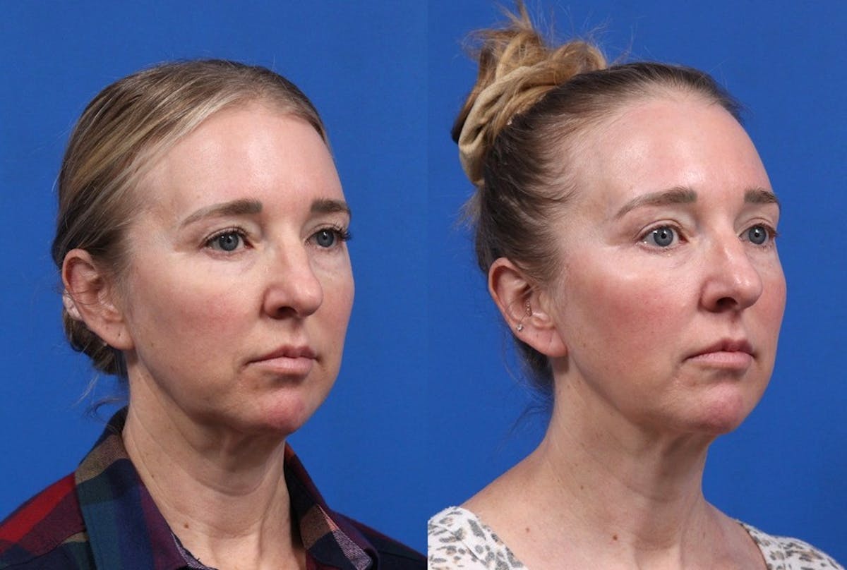 XERF Gallery Before & After Gallery - Patient 376951 - Image 1