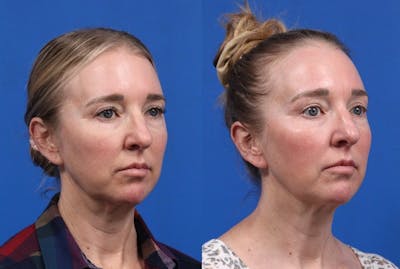 XERF Gallery Before & After Gallery - Patient 376951 - Image 1