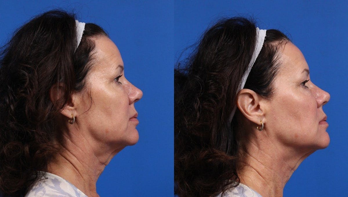 XERF Gallery Before & After Gallery - Patient 110998 - Image 1