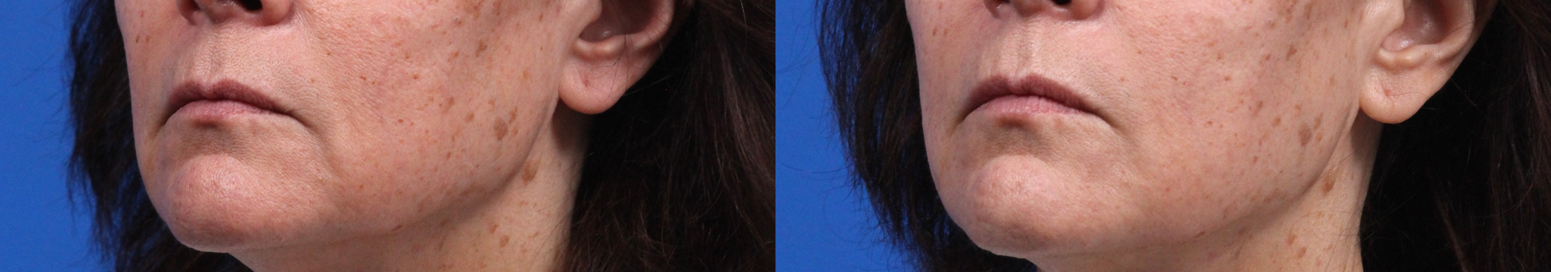 XERF Gallery Before & After Gallery - Patient 329630 - Image 1