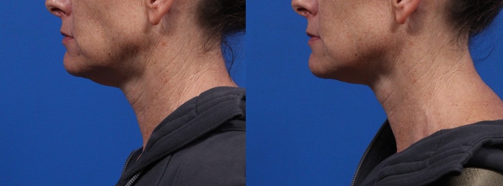 XERF Gallery Before & After Gallery - Patient 103376 - Image 1