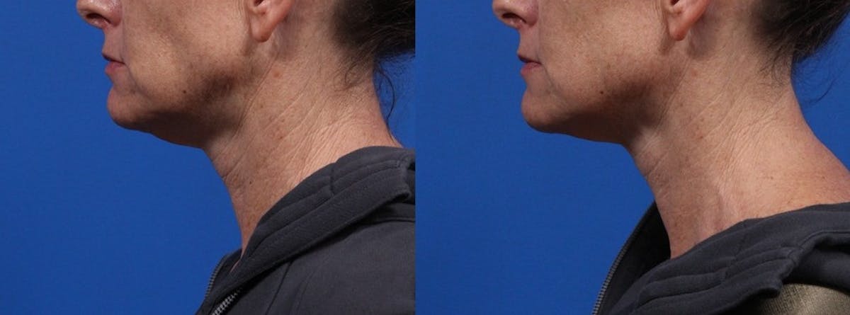 XERF Gallery Before & After Gallery - Patient 103376 - Image 1