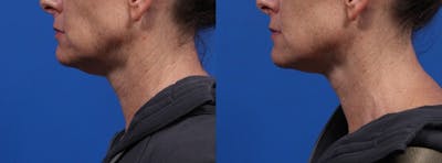 XERF Gallery Before & After Gallery - Patient 103376 - Image 1