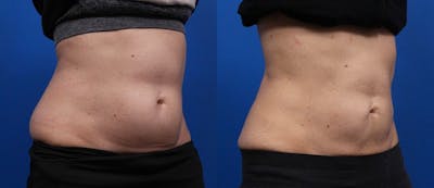 CoolSculpting Gallery Before & After Gallery - Patient 193659 - Image 2
