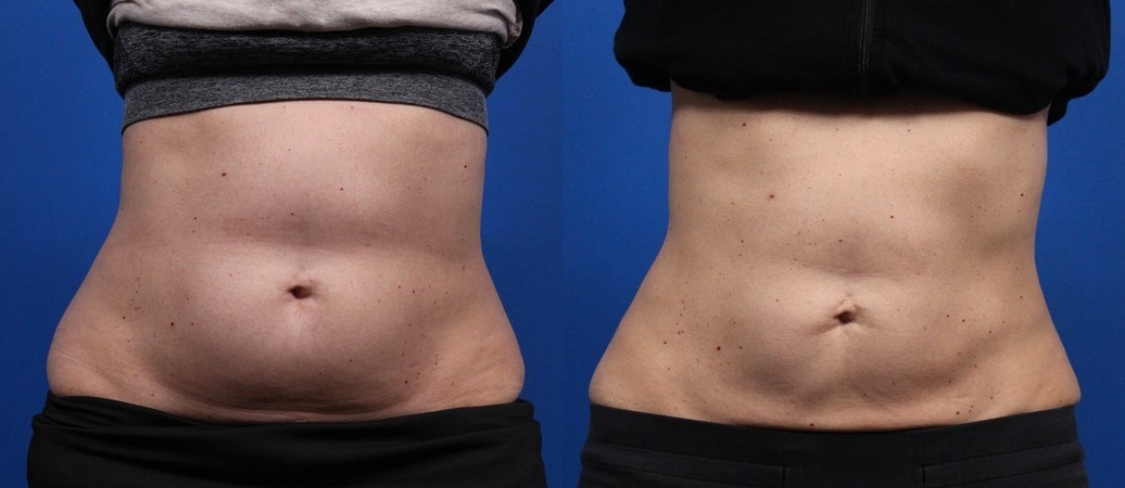 CoolSculpting Gallery Before & After Gallery - Patient 193659 - Image 1