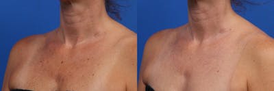 HALO® Laser by Sciton Gallery Before & After Gallery - Patient 308744 - Image 1