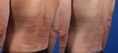 Morpheus8 Gallery Before & After Gallery - Patient 214228 - Image 2