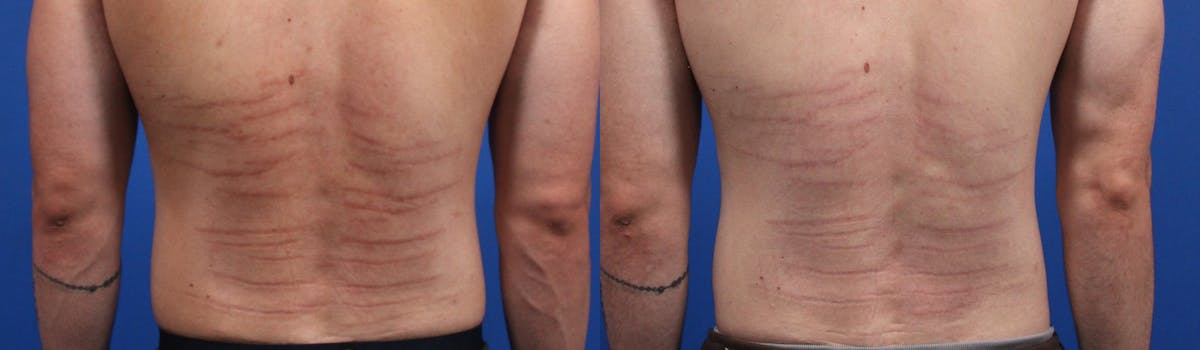 Morpheus8 Gallery Before & After Gallery - Patient 214228 - Image 1