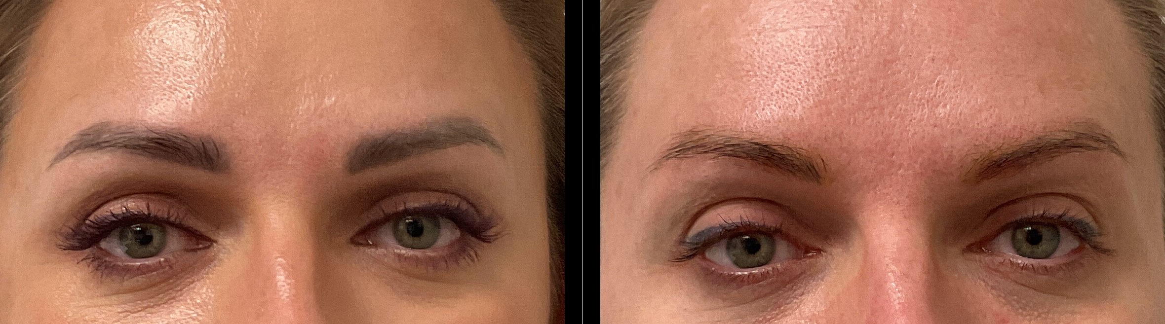 PiQo4™ Laser Gallery Before & After Gallery - Patient 422067 - Image 1