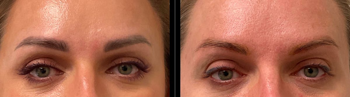PiQo4™ Laser Gallery Before & After Gallery - Patient 422067 - Image 1