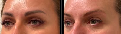 PiQo4™ Laser Gallery Before & After Gallery - Patient 422067 - Image 2
