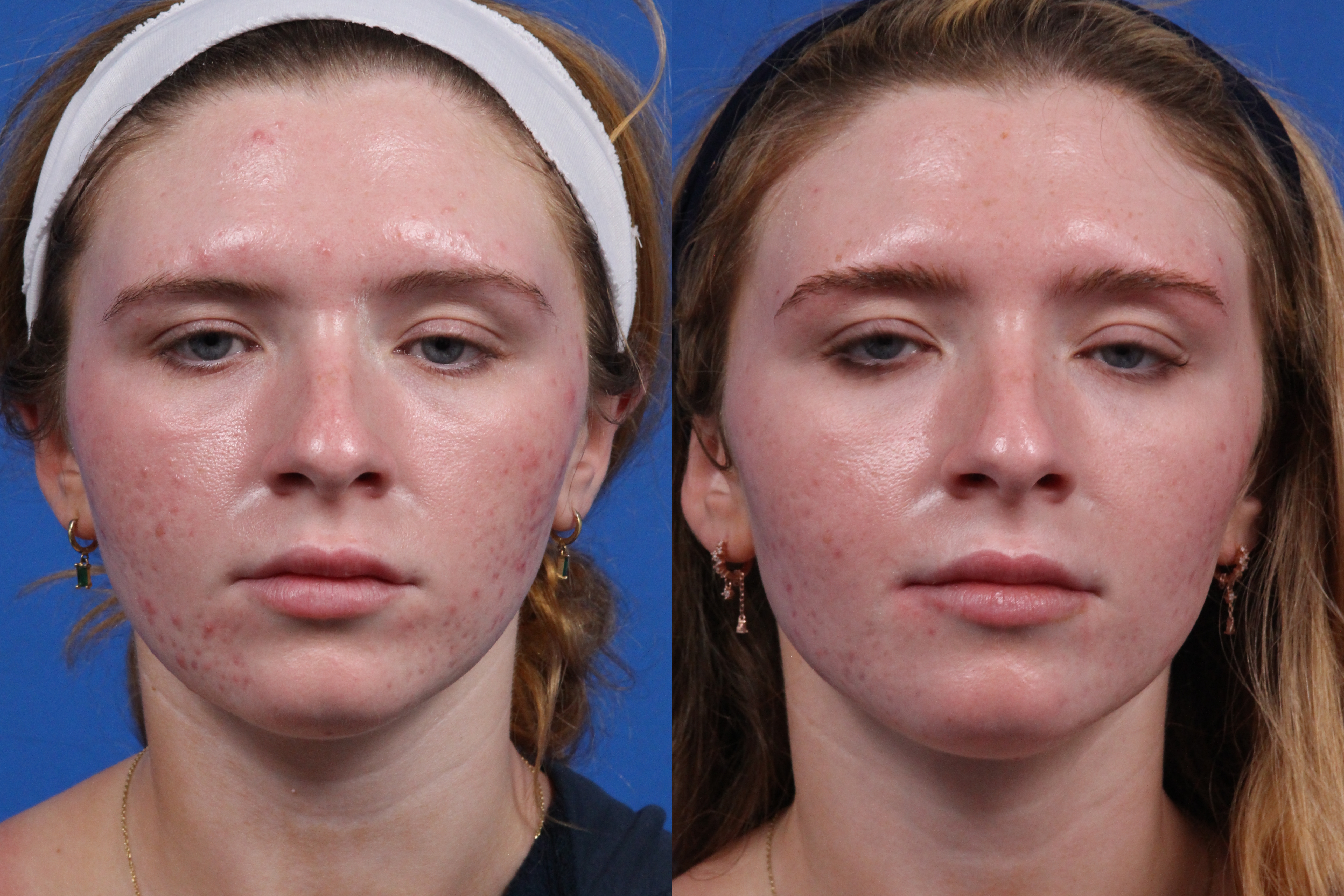 BBL Clear Gallery Before & After Gallery - Patient 400218 - Image 1