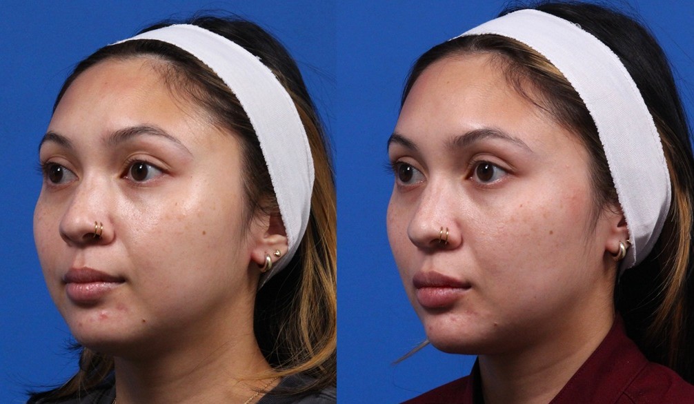 Dermal Fillers Gallery Before & After Gallery - Patient 104657 - Image 1