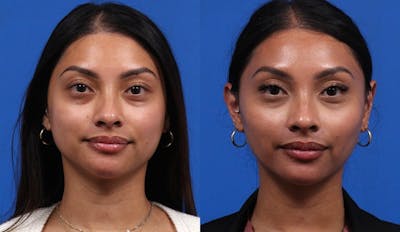 EZ Gel PRF Before & After Gallery - Patient 659755 - Image 1
