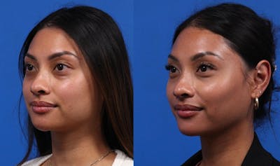 EZ Gel PRF Before & After Gallery - Patient 659755 - Image 2