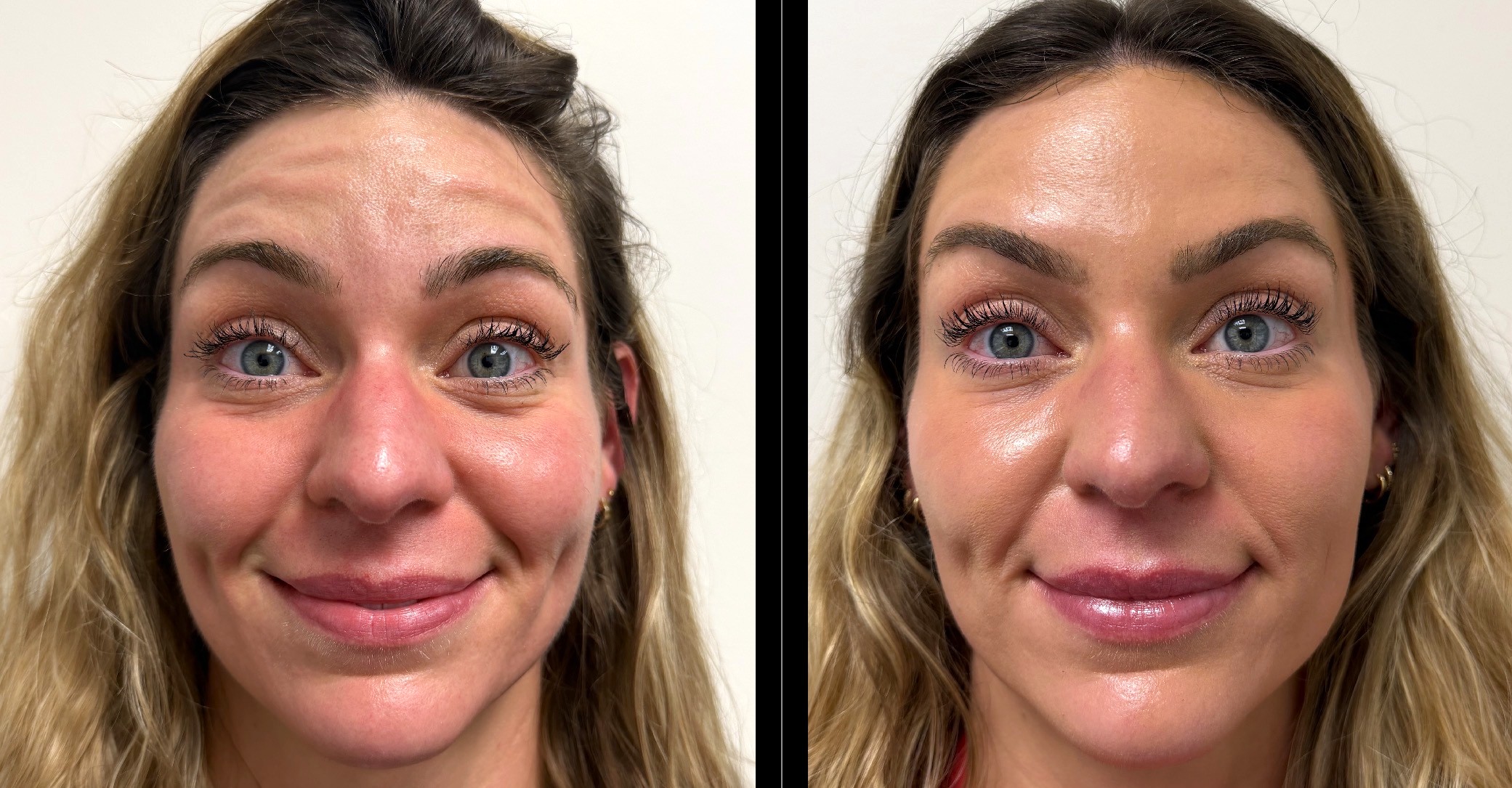 Botox/ Dysport/ Xeomin Gallery Before & After Gallery - Patient 336410 - Image 1