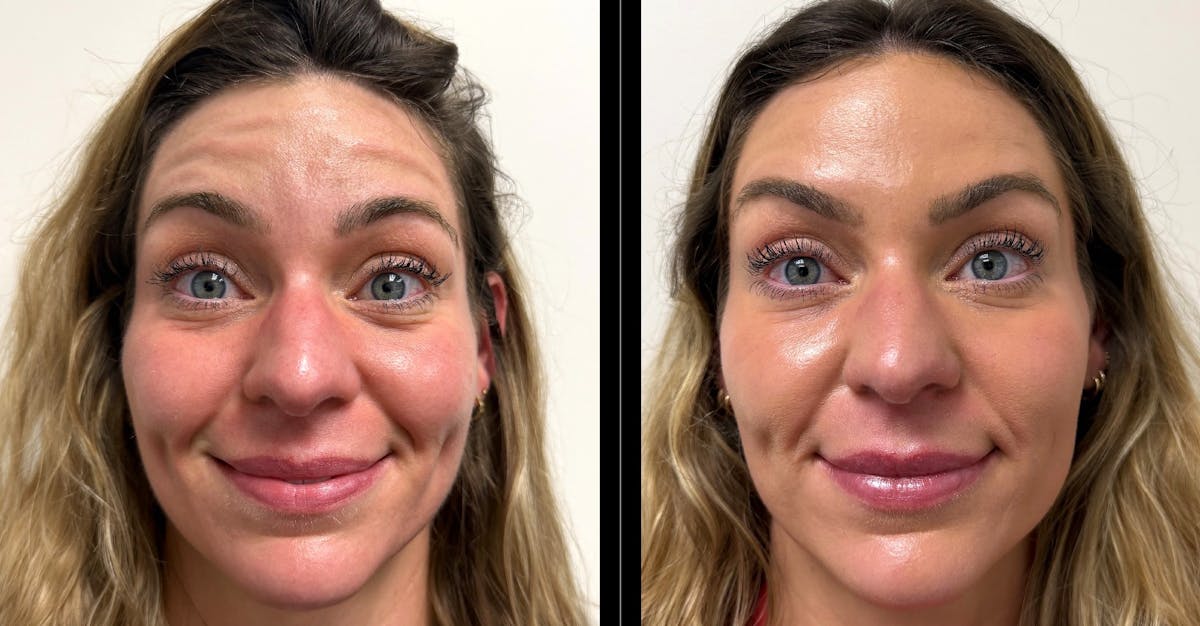 Botox/ Dysport/ Xeomin Gallery Before & After Gallery - Patient 336410 - Image 1