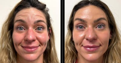 Botox/ Dysport/ Xeomin Gallery Before & After Gallery - Patient 336410 - Image 1