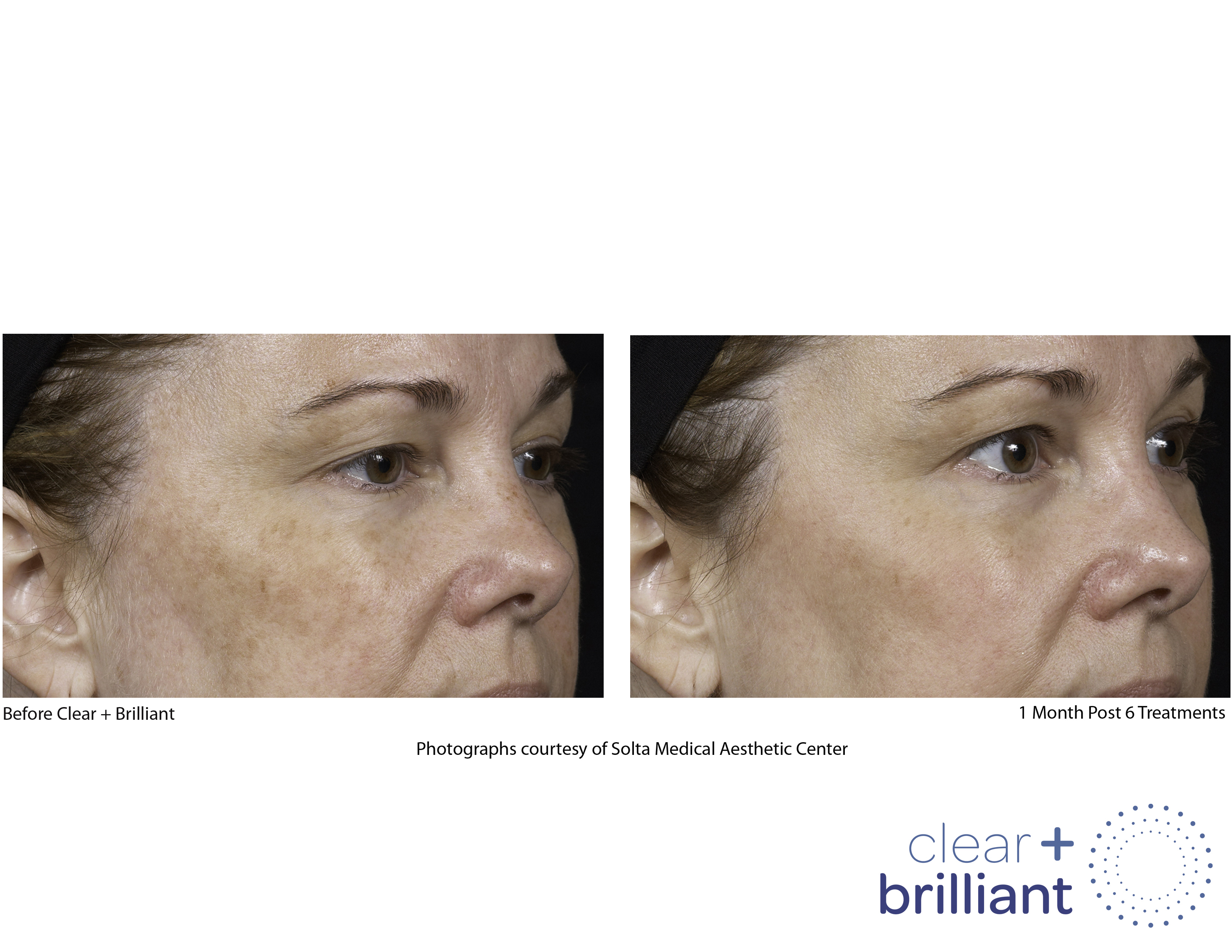 Clear + Brilliant Gallery Before & After Gallery - Patient 689319 - Image 1