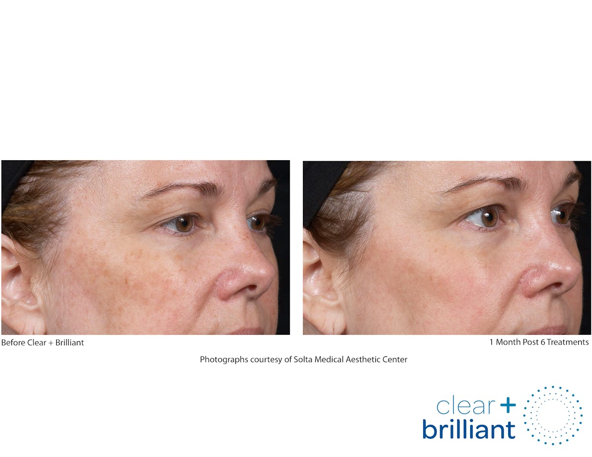 Clear + Brilliant Gallery Before & After Gallery - Patient 689319 - Image 1