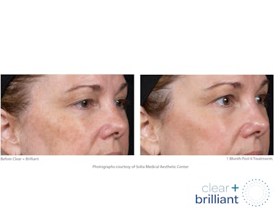 Clear + Brilliant Gallery Before & After Gallery - Patient 689319 - Image 1