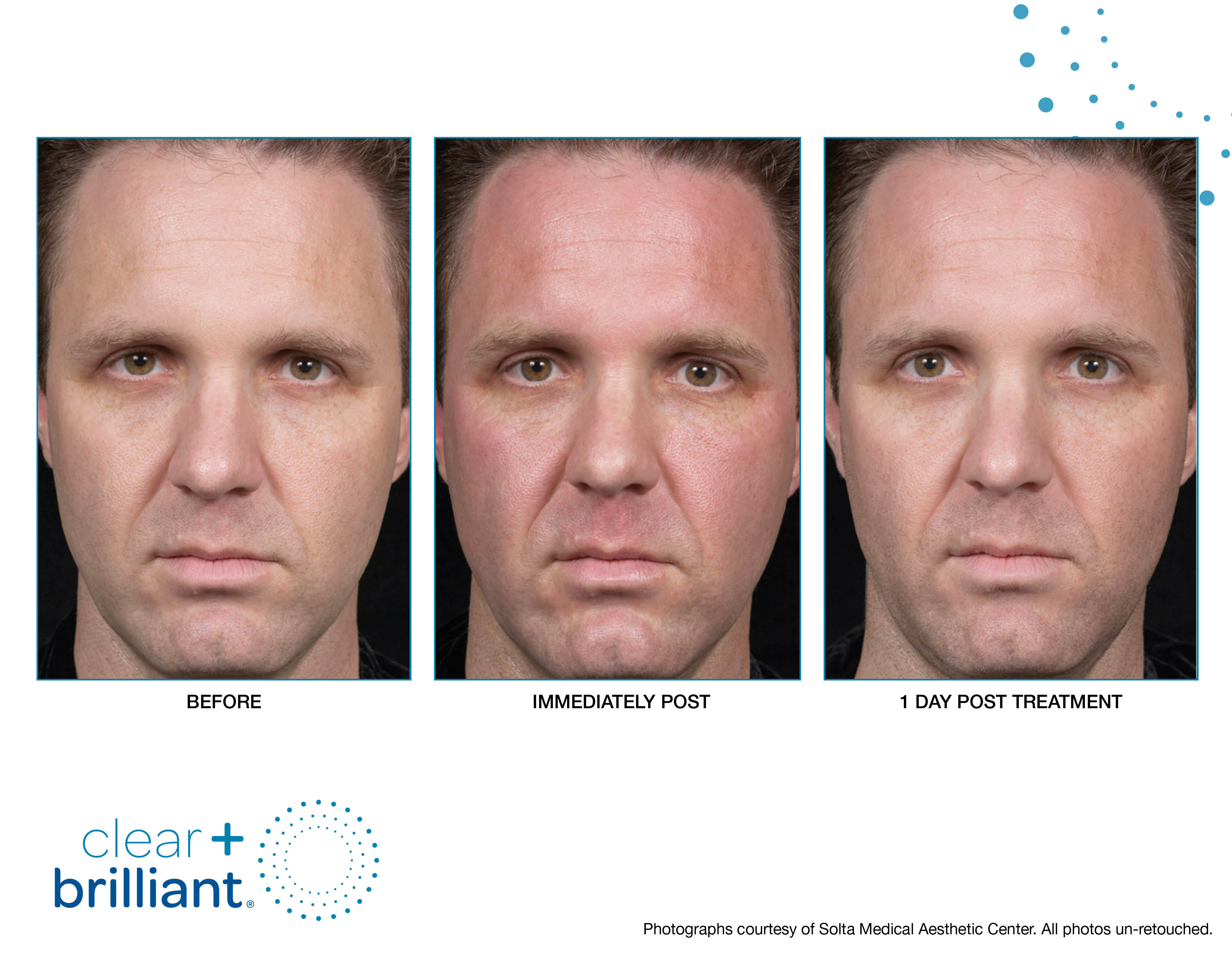 Clear + Brilliant Gallery Before & After Gallery - Patient 159188 - Image 1