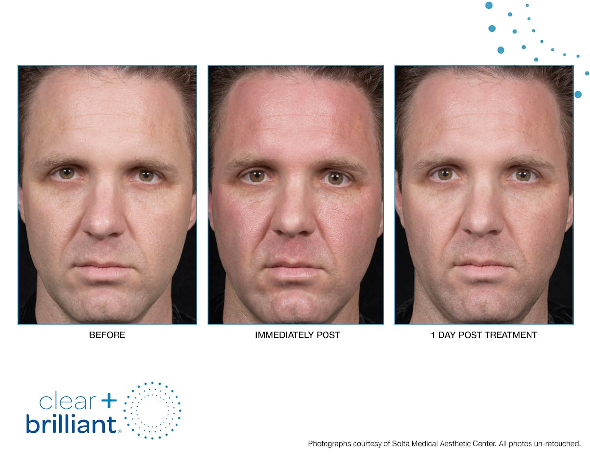 Clear + Brilliant Gallery Before & After Gallery - Patient 159188 - Image 1