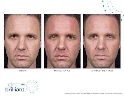 Clear + Brilliant Gallery Before & After Gallery - Patient 159188 - Image 1