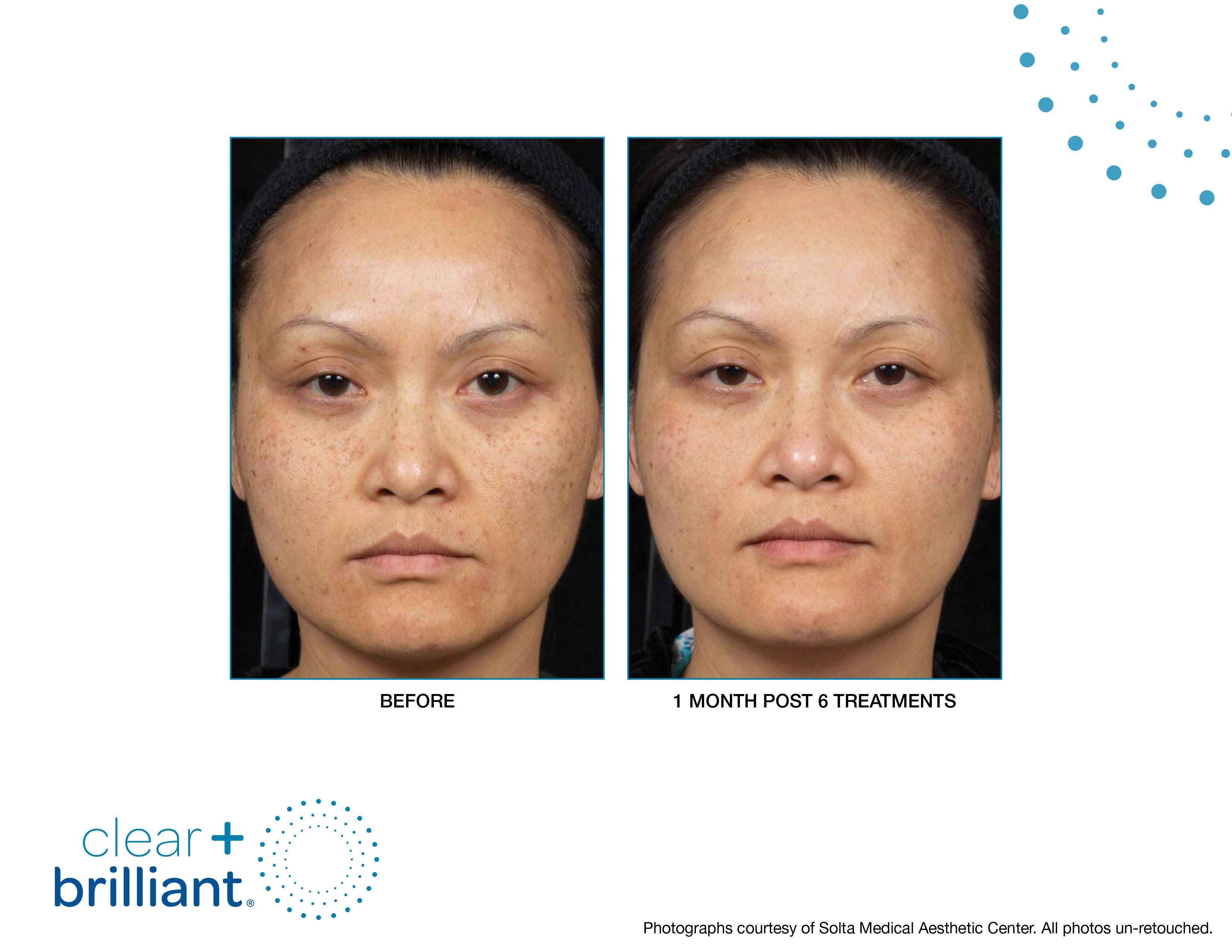 Clear + Brilliant Gallery Before & After Gallery - Patient 640567 - Image 1