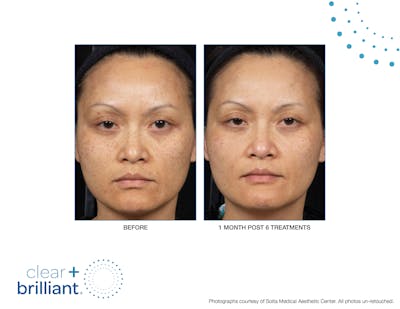Clear + Brilliant Gallery Before & After Gallery - Patient 640567 - Image 1