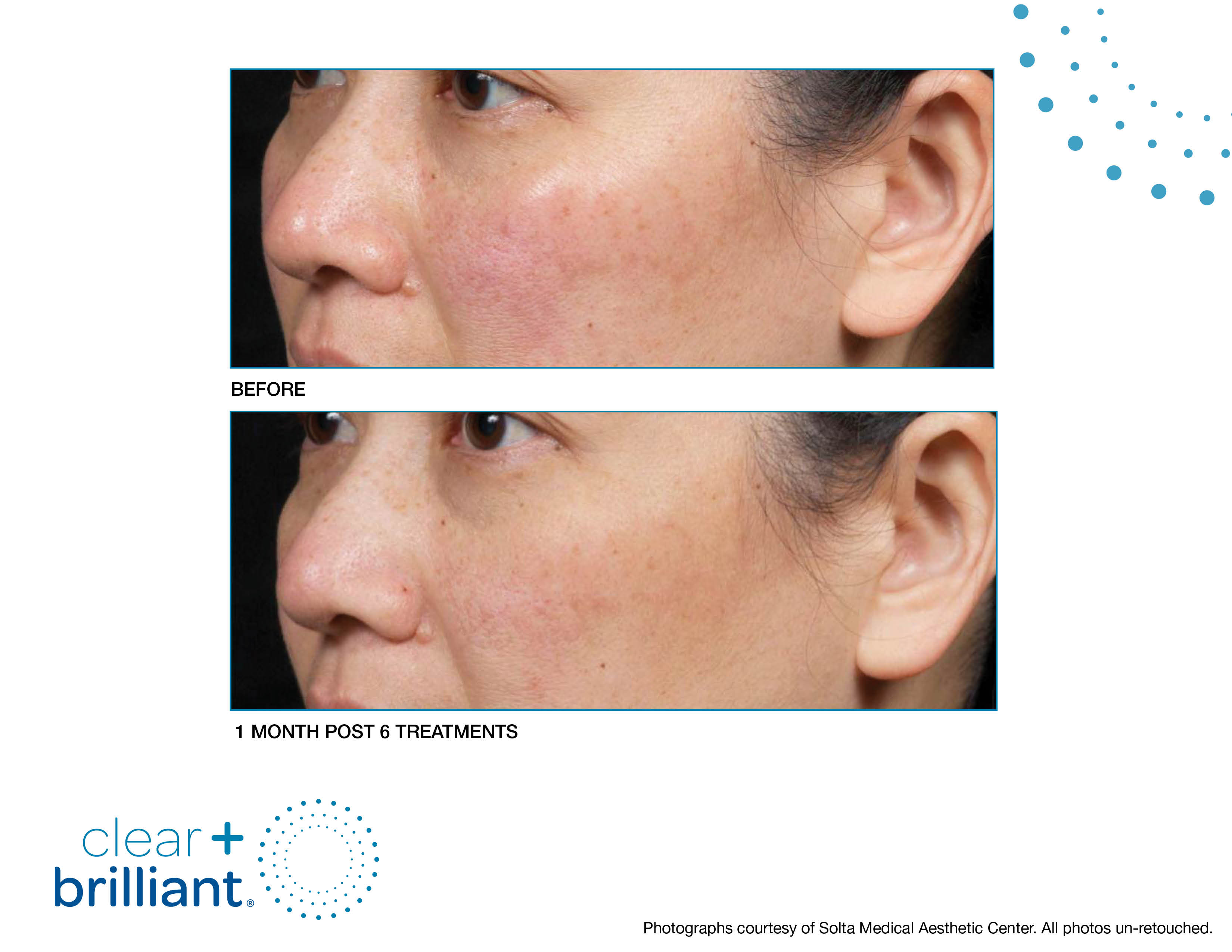 Clear + Brilliant Gallery Before & After Gallery - Patient 432952 - Image 1