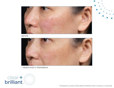 Clear + Brilliant Gallery Before & After Gallery - Patient 432952 - Image 1
