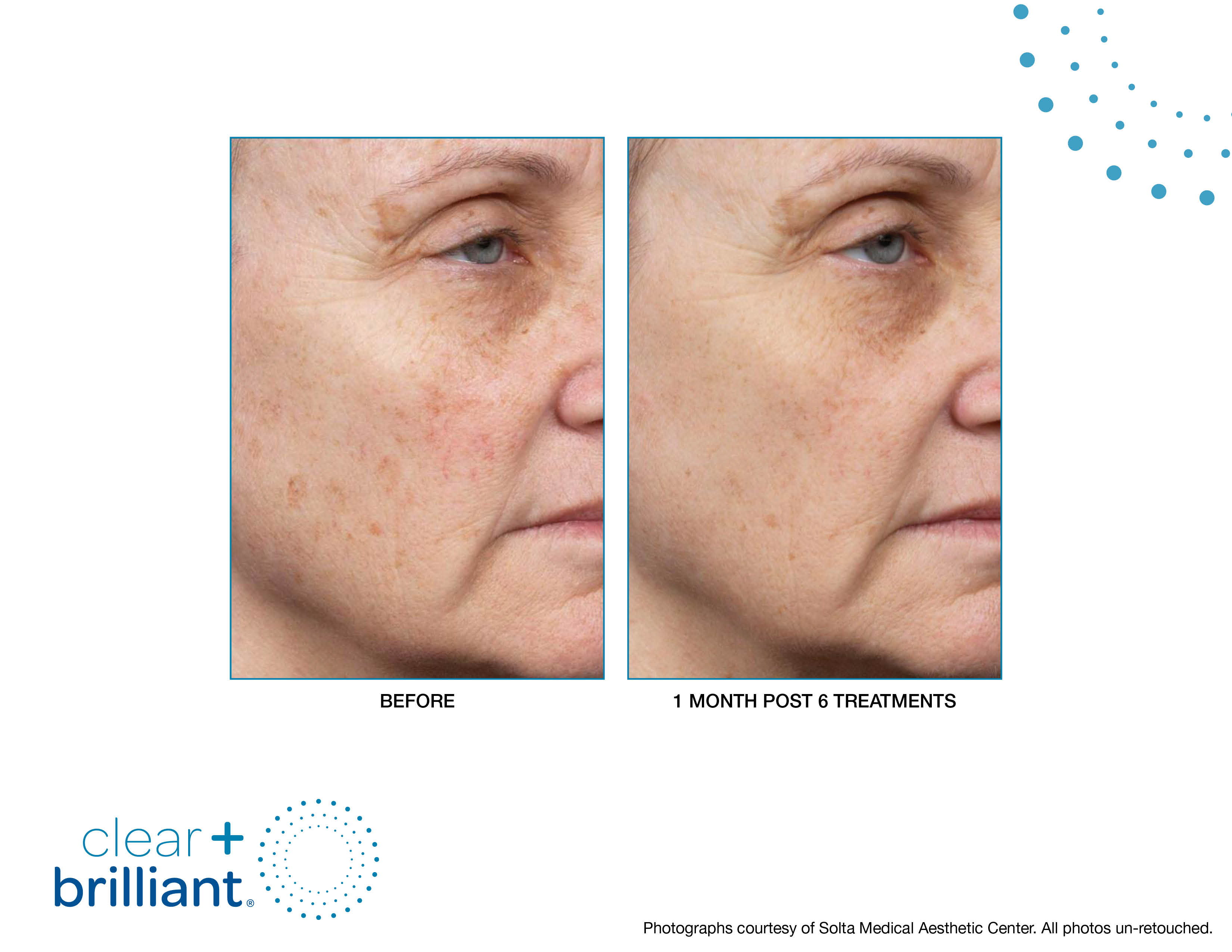 Clear + Brilliant Gallery Before & After Gallery - Patient 132845 - Image 1
