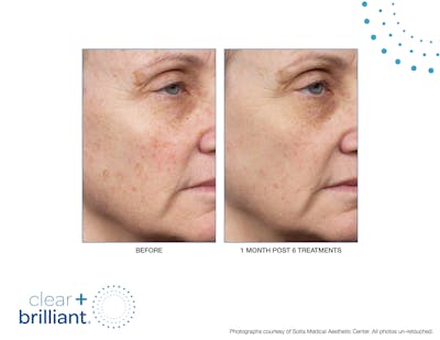 Clear + Brilliant Gallery Before & After Gallery - Patient 132845 - Image 1